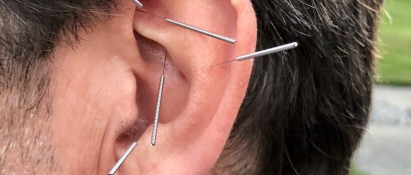 Auriculartherapy